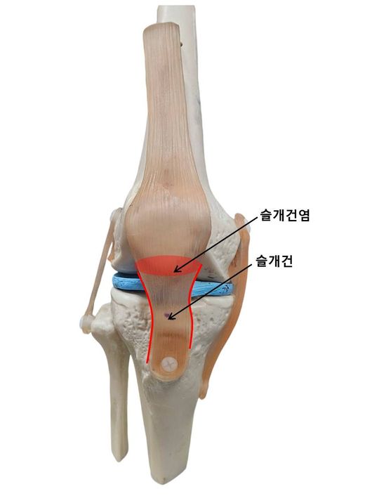 슬개건염은 슬개골(무릎뼈)과 슬개건의 접합부위 힘줄에 염증이 생기는 질환이다. 이 질환의 다른 이름이 '러너의 무릎(Runner's knee)'인걸 보면 많이 뛰면 문제가 생긴다는 것을 알 수 있다.