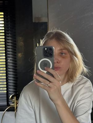 '스케이트 날에 안면 충돌' 피 철철 흘린 女 선수, 손흥민 받았던 그 수... - 뉴스 썸네일 이미지