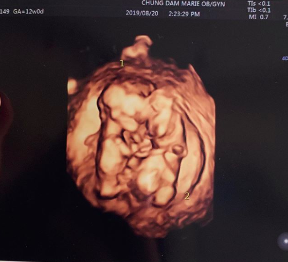 [사진=율희 SNS] 율희가 직접 공개한 쌍둥이 초음파 사진.