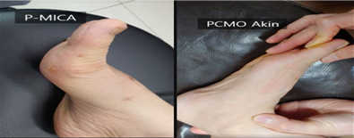 수술 1년후 최소침습 흉터(왼쪽)와 일반절개후 흉터.