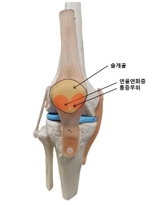 슬개골연골연화증이 생기면 일단 통증을 유발하는 운동이나 자세를 피해야 한다. / 셔터스톡