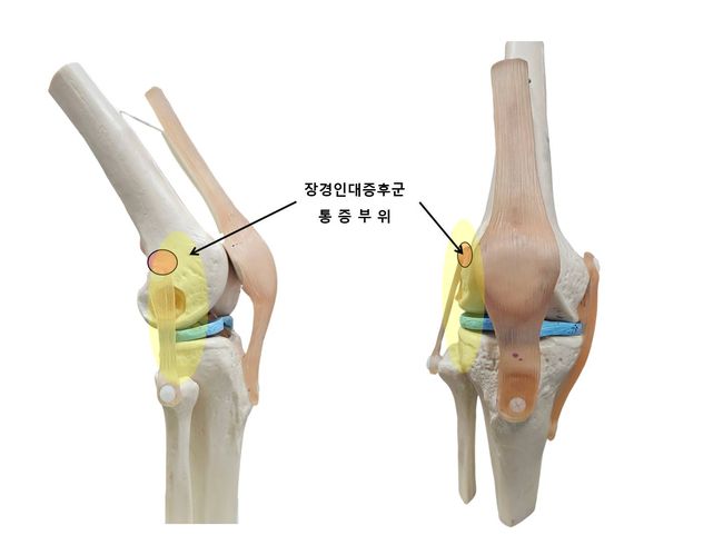 장경인대와 연결된 엉덩이 근육과 대퇴근막장근을 함께 풀어주는 것도 도움이 된다. / 셔터스톡