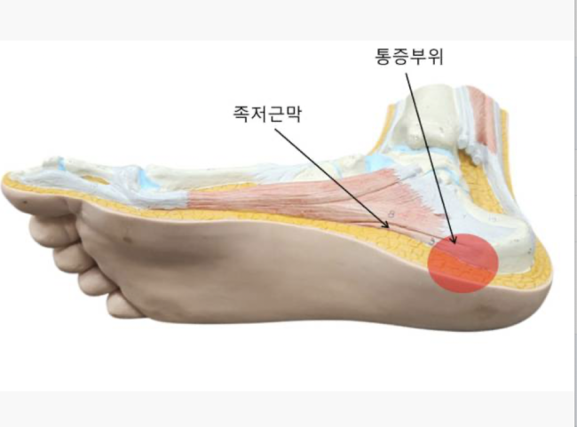 족저근막염은 말 그대로 ‘발바닥 아치를 지탱하고 있는 근막에 염증이 생기는 질환’이다. / 셔터스톡스 