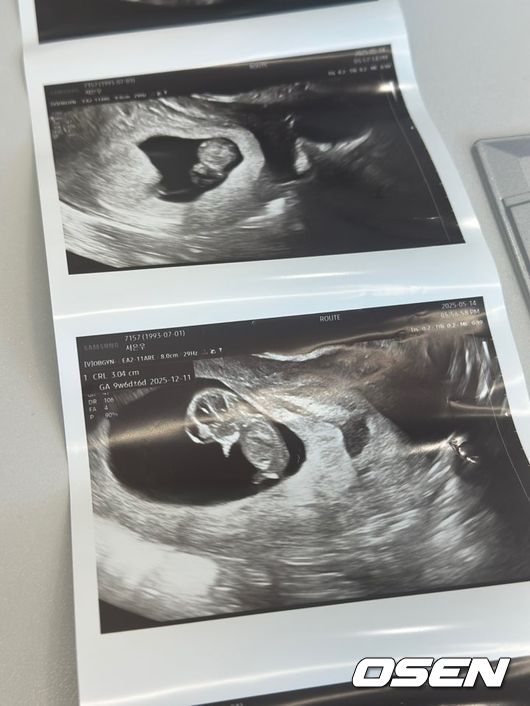 [사진] 인터뷰 당일 서민재가 공개한 초음파 사진.