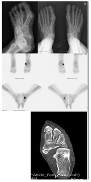 부주상골 증후군 엑스레이 CT 사진. 